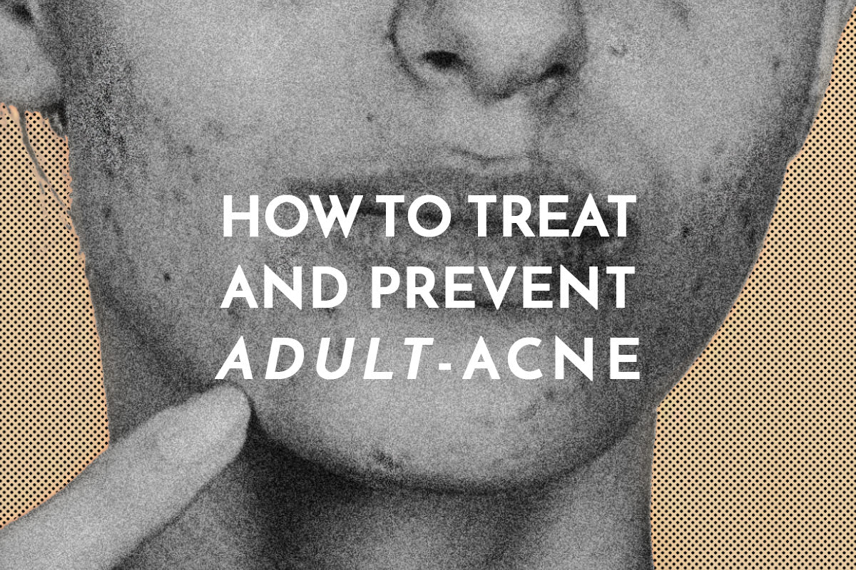 How to effectively get rid of and prevent adult acne. Combat breakouts and pimples